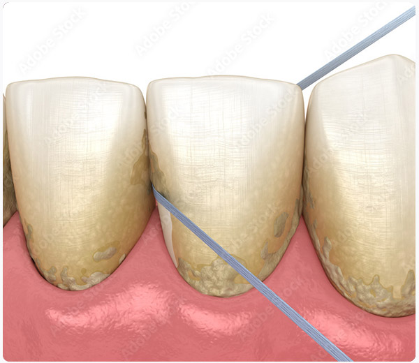 Dental FLoss Flossing Teeth Illustration | My Dental Advocate