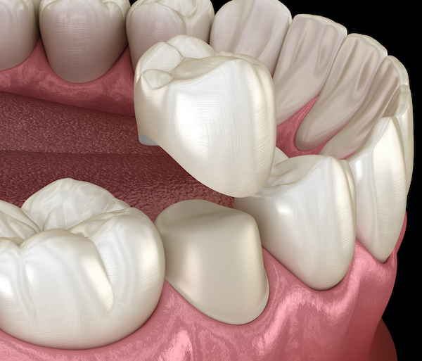 Are crowns necessary | Dental crown premolar tooth assembly process.illustration | My Dental Advocate