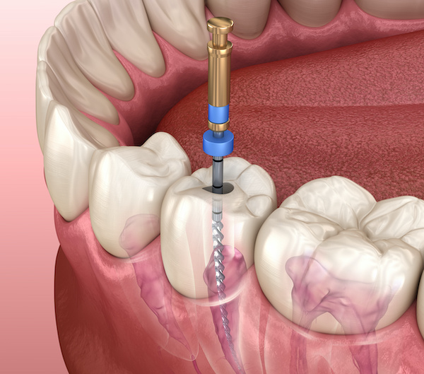 Are Root Canals Necessary | Endodontic root canal treatment process illustration