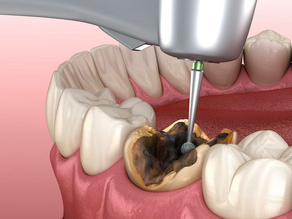 Cavity removing process | Medically accurate illustration | My Dental Advocate