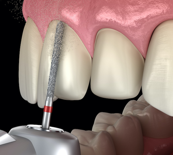 Central Incisor preparation process for dental crowns or Veneer placement | My Dental Advocate