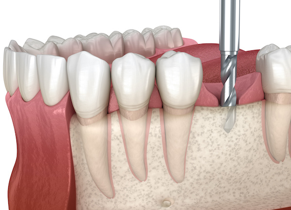 Dental Specialist - Oral Surgeon | Drilling of the bone for dental implant illustration | My Dental Advocate