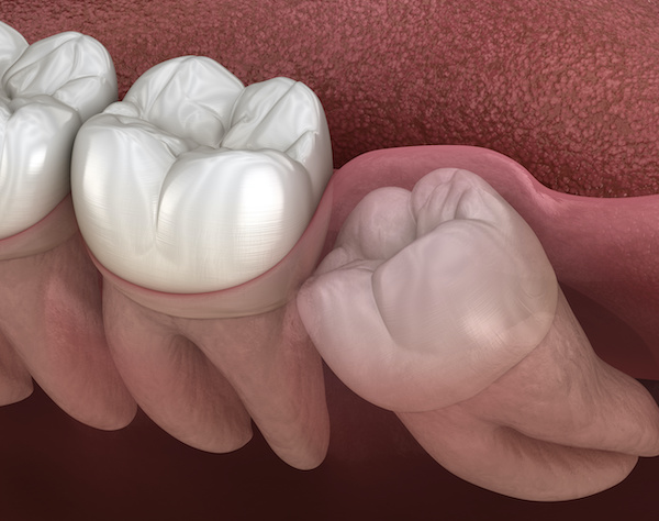 Dental Specialist - Oral Surgeon | Healthy teeth and wisdom tooth with mesial impaction | My Dental Advocate