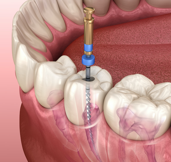 Endodontic therapy | root canal treatment process | Medically accurate tooth 3D illustration