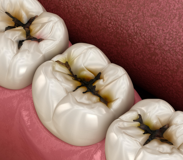 Molar teeth damaged by cavities | Medically accurate illustration | My Dental Advocate