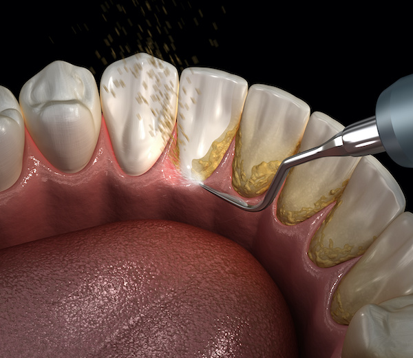 Periodontal Disease Treatment | Ultrasonic teeth cleaning machine removing plaque