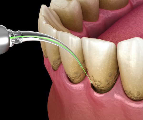Periodontal Maintenance and Treatment | Medically accurate illustration | My Dental Advocate