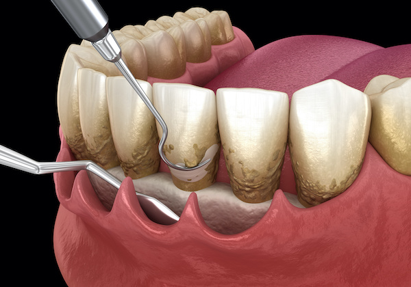 Periodontist: The Gum Specialist | Scaling and root planing illustration | conventional periodontal therapy 