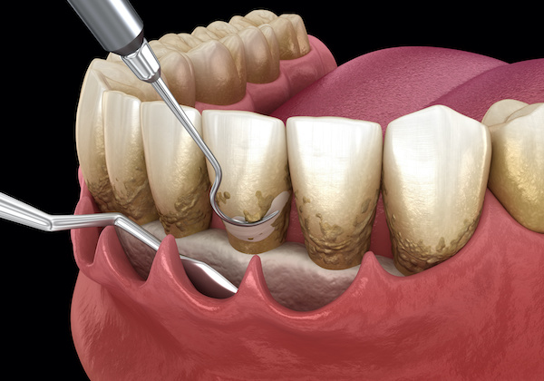 https://mydentaladvocate.com/wp-content/uploads/2021/12/periodontal-osseous-surgery.jpg