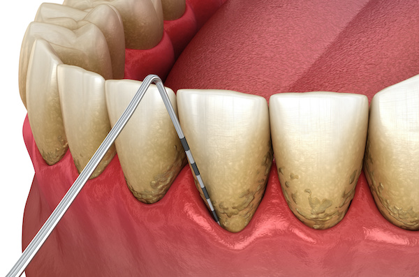 Periodontal Testing and Probings gum recession process illustration | My Dental Advocate