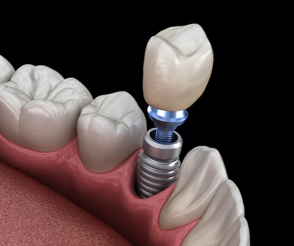 Periodontist: The Gum Specialist | Premolar tooth crown installation illustration 