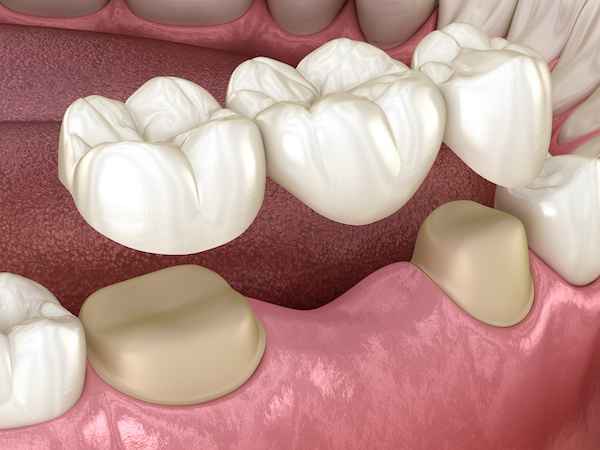 Dental crowns bridge of 3 teeth over molar and premolar illustration | Ceramic Dental Crowns are best
