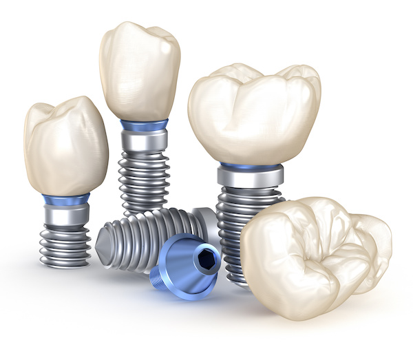 Dental Implants. 3D illustration concept | What are dental implants | My Dental Advocate