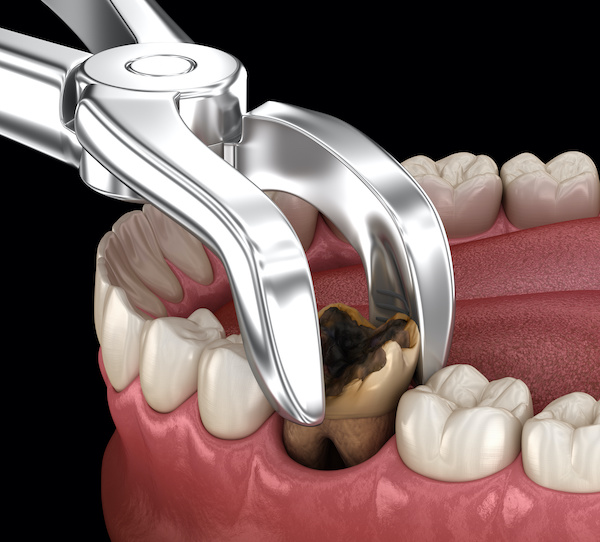 Teeth Extractions | Extraction of Molar tooth damaged by cavities illustration | My Dental Advocate