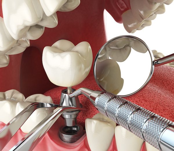 Dental implantation concept | Why do dental implants fail | My dental advocate