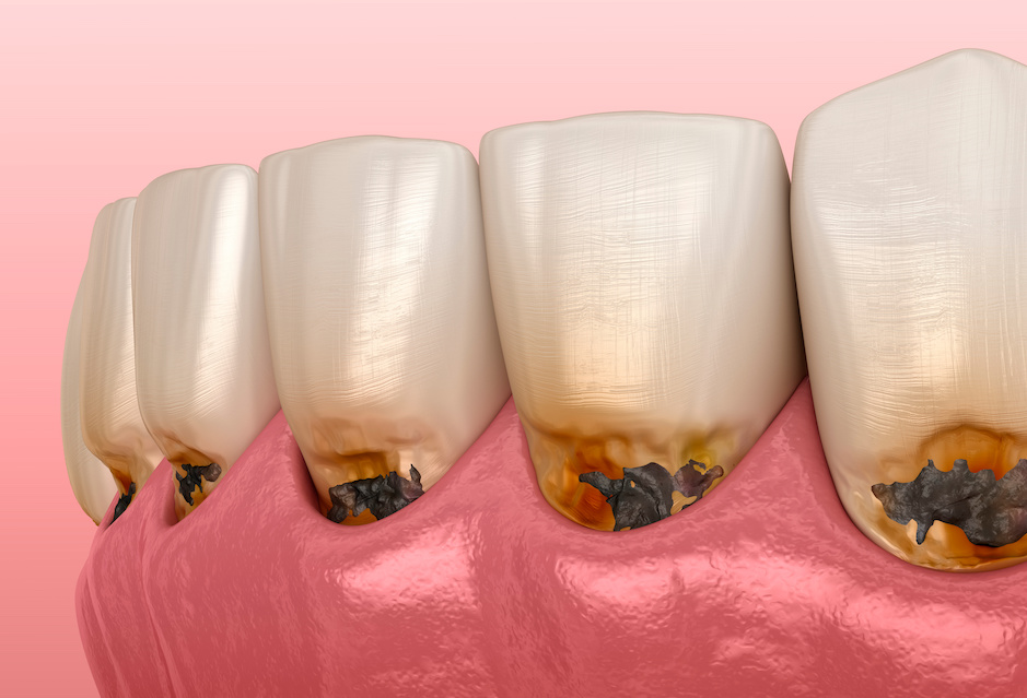 Teeth with Cavities | Can You Reverse a Cavity? (5 Simple Steps) | My Dental Advocate