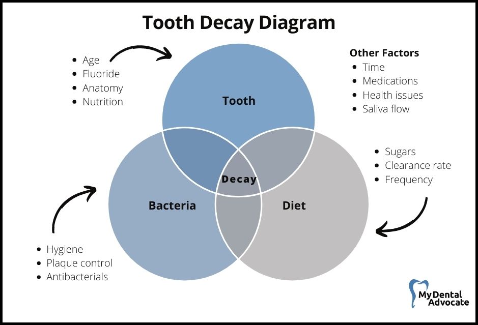 Tooth Decay Diagram | Can You Reverse a Cavity (5 Simple Steps) | My Dental Advocate