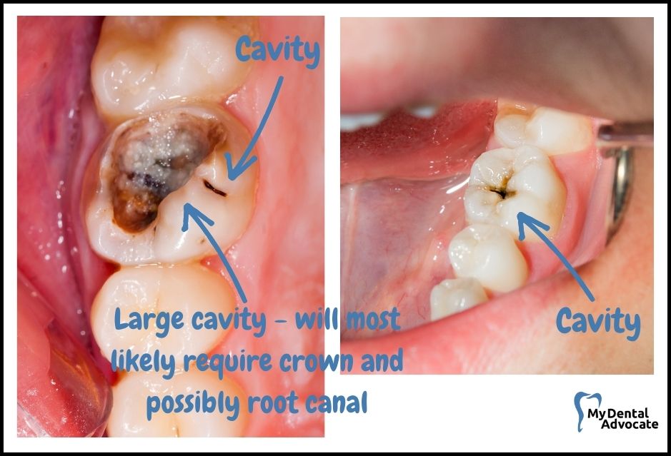 What Does a Cavity Look Like? (20 Pictures) | Tooth decay - intraoral camera - 1 | My Dental Advocate