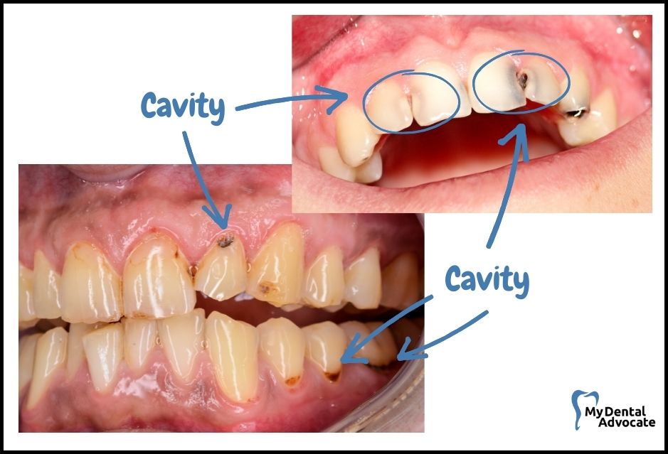 What Does a Cavity Look Like? (20 Pictures) | Tooth decay - intraoral camera - 6 | My Dental Advocate
