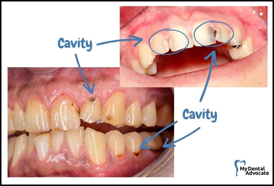 cavity side of molar