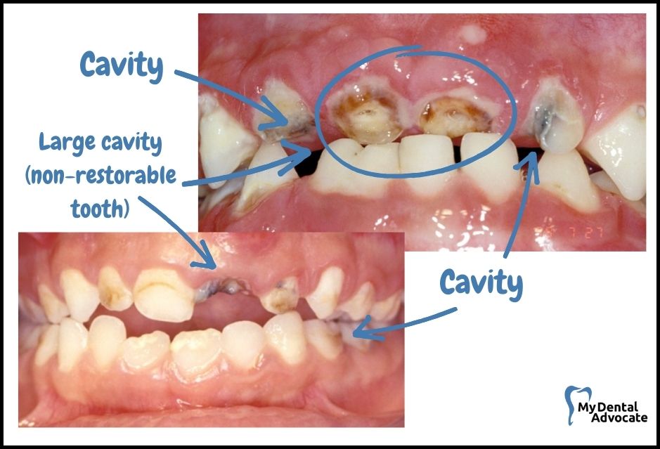 What Does a Cavity Look Like? (20 Pictures) | Tooth decay - intraoral camera - 7 | My Dental Advocate