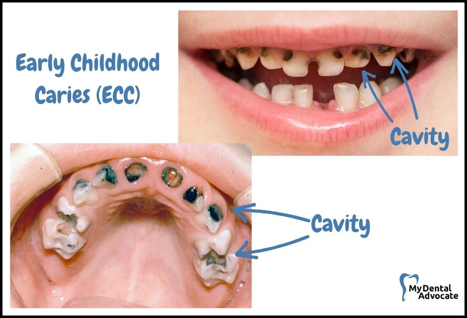 What Does a Cavity Look Like? (20 Pictures) | Tooth decay - intraoral camera - 8 | My Dental Advocate