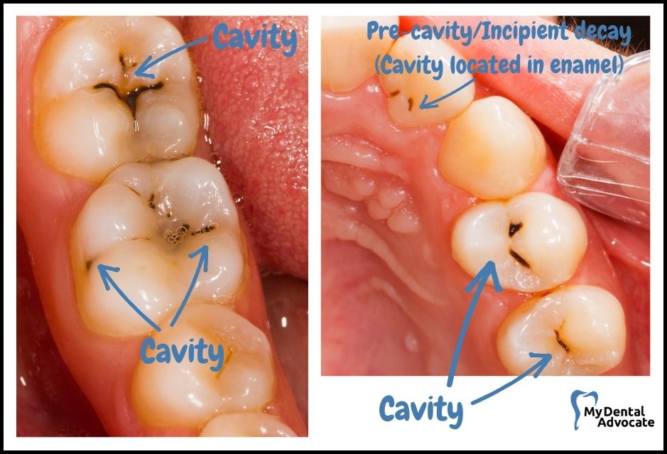 what do cavities look like before the treatment