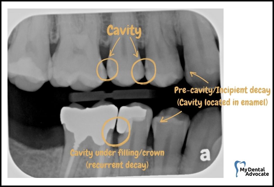 What Does a Cavity Look Like? (20 Pictures) | Tooth decay - x-ray - 1 | My Dental Advocate