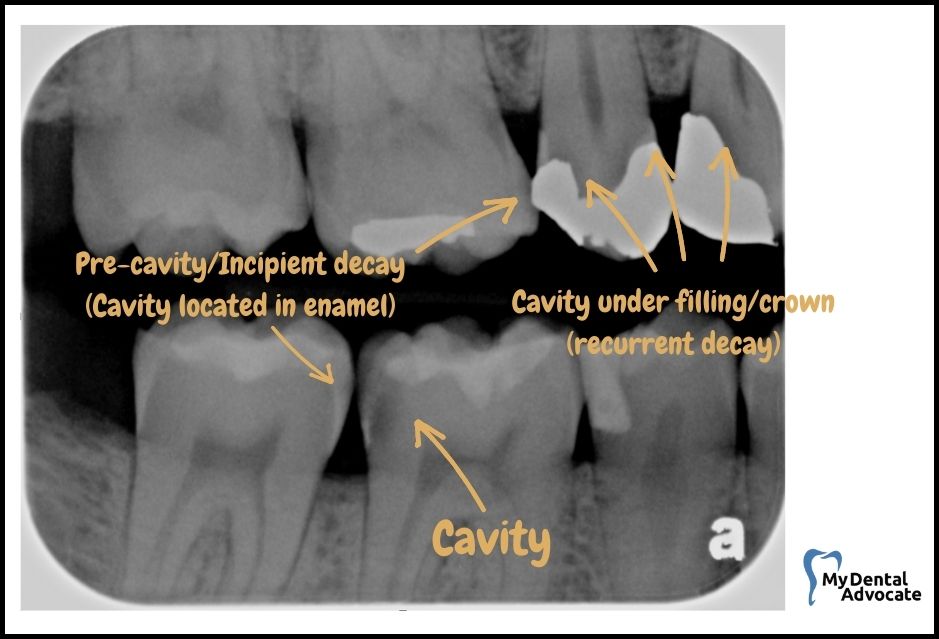 early cavity xray