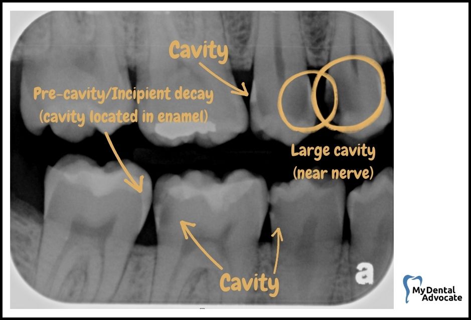 What Does A Cavity Look Like