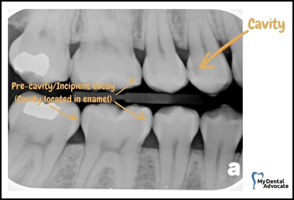 What Does a Cavity Look Like? (20 Pictures) | Tooth decay - x-ray - 4 | My Dental Advocate
