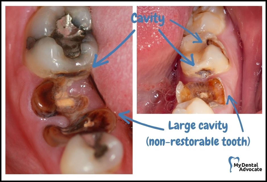 What Does a Cavity Look Like? (20 Pictures) | Tooth decay - intraoral camera - 3 | My Dental Advocate