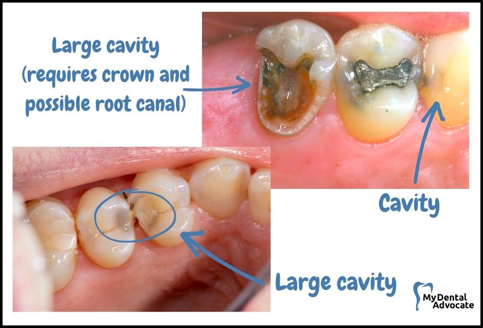 severe molar decay