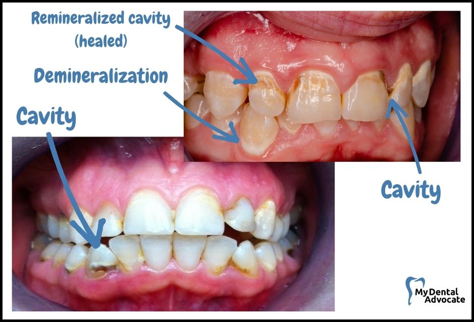 What Does a Cavity Look Like? (20 Pictures) | Tooth decay - intraoral camera - 5 | My Dental Advocate