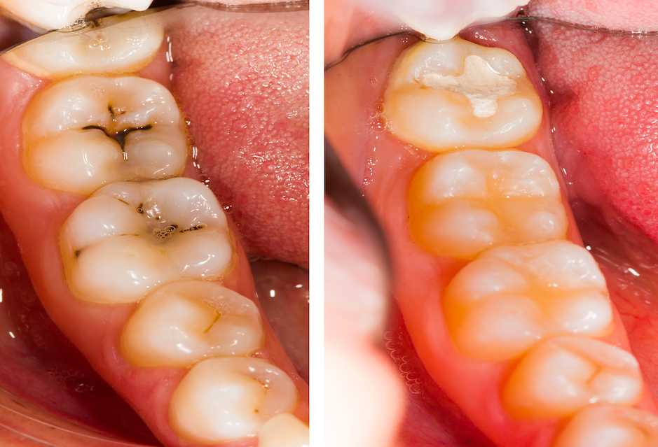 Cavities and fillings | What is a Cavity? What Causes Rotten Teeth? | My Dental Advocate