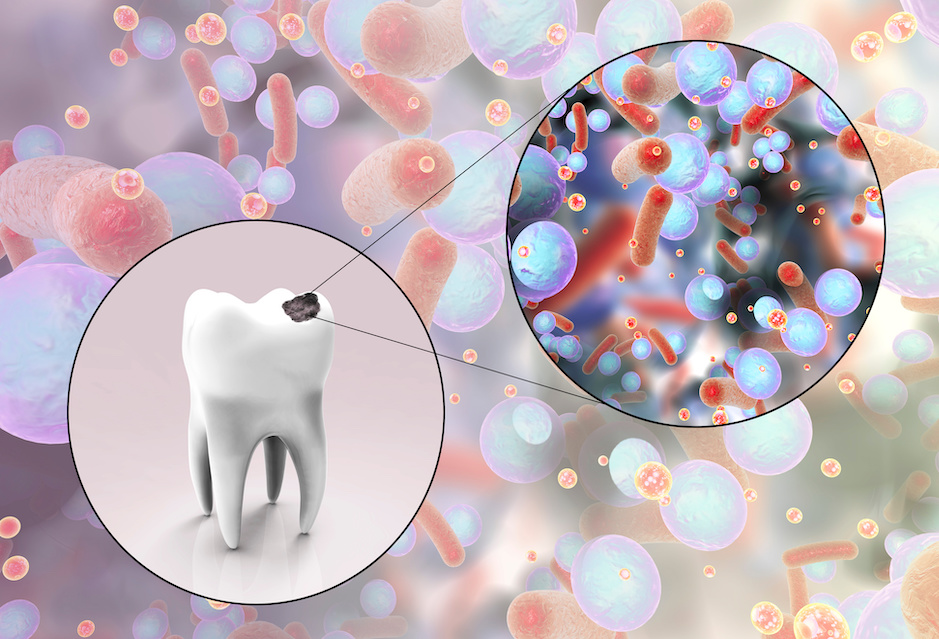 Bacteria Picture | What is a Cavity? What Causes Rotten Teeth? | My Dental Advocate