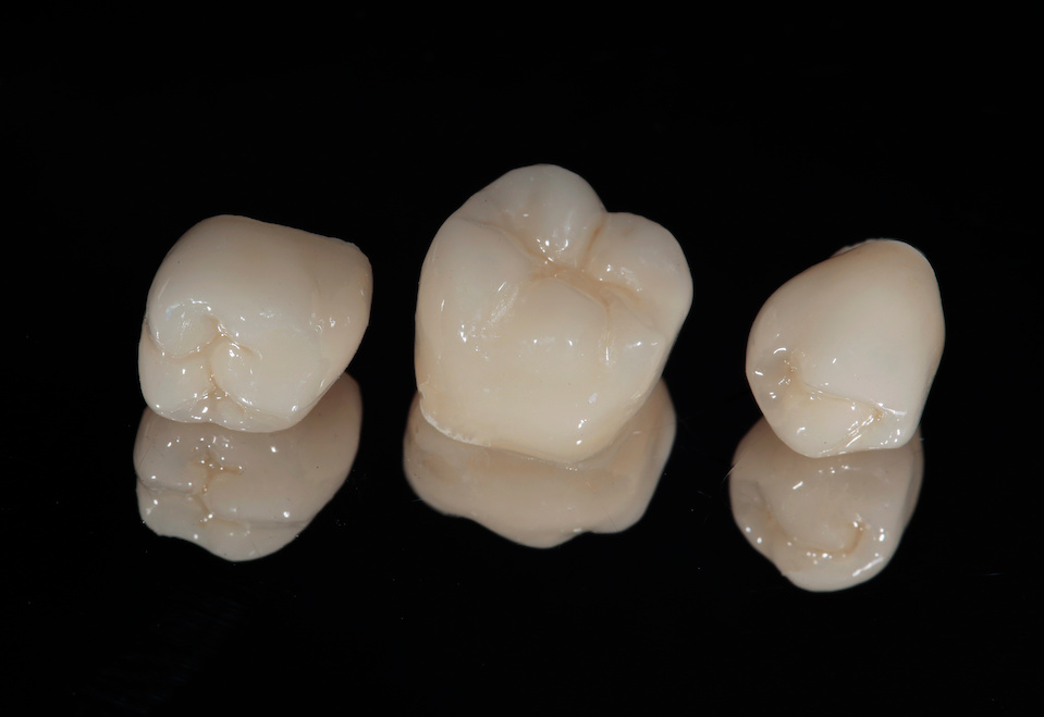 CEREC Crown Ceramic | My Dental Advocate