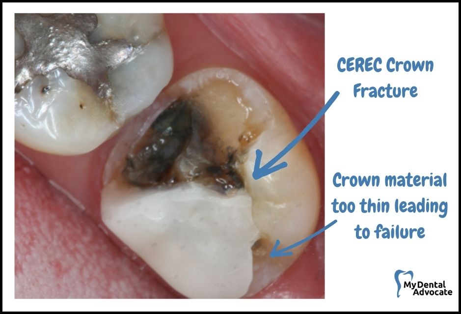 CEREC Crown Fracture | My Dental Advocate