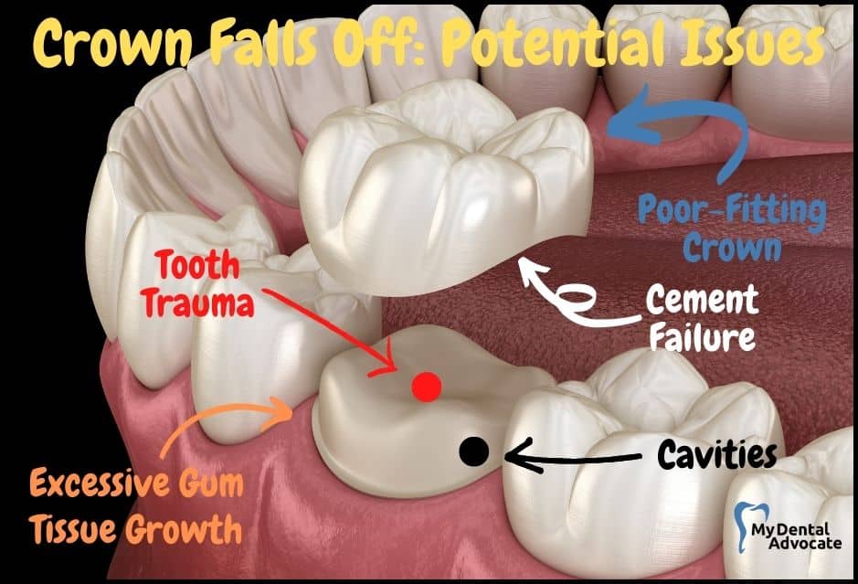 Potential Issues If a Crown Falls Off | My Dental Advocate