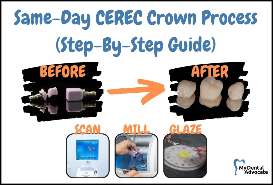 Same-Day CEREC Crown Process (Step-By-Step Guide) | My Dental Advocate