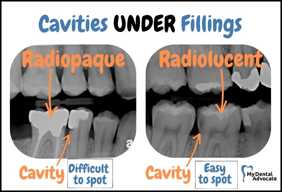 Cavities Under Fillings on X-rays | My Dental Advocate