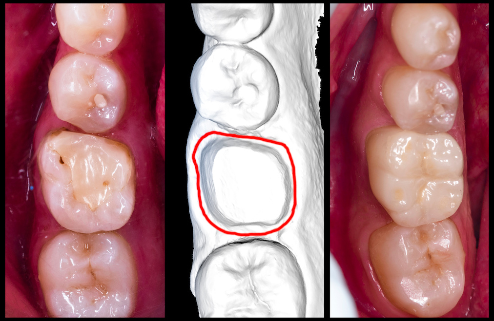 CEREC crown scan, design, cementation | My Dental Advocate