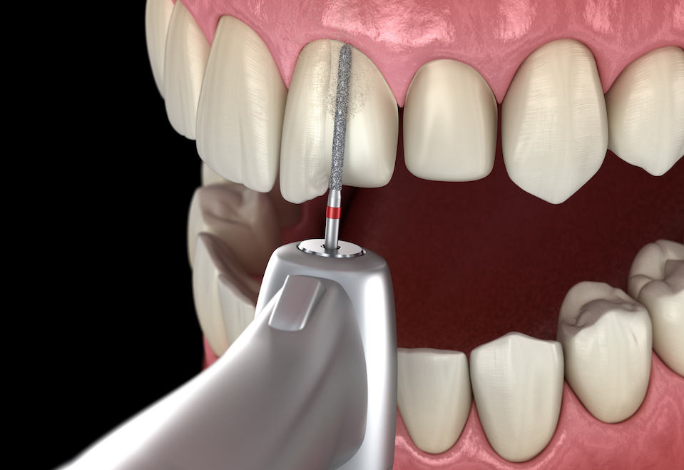Dental Drill Cutting Tooth | My Dental Advocate