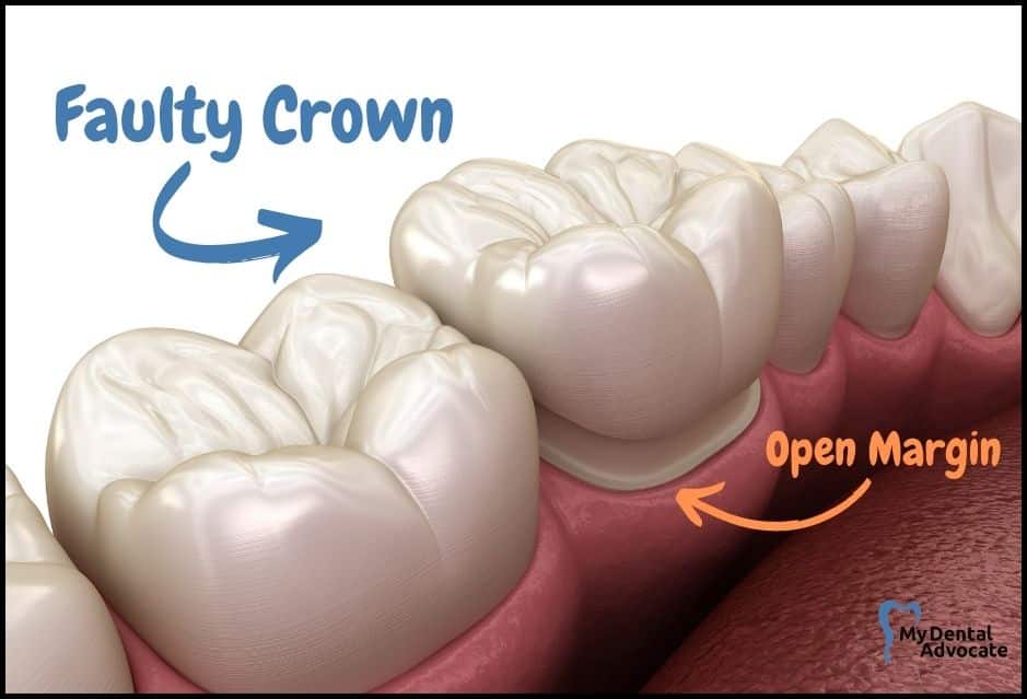 Faulty Crown Open Margin | My Dental Advocate