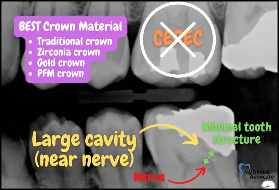 Large Cavity (near nerve) | My Dental Advocate