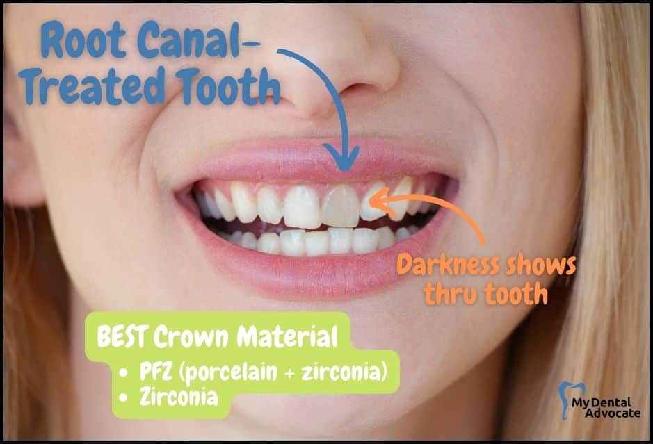 Root Canal-Treated Tooth | My Dental Advocate