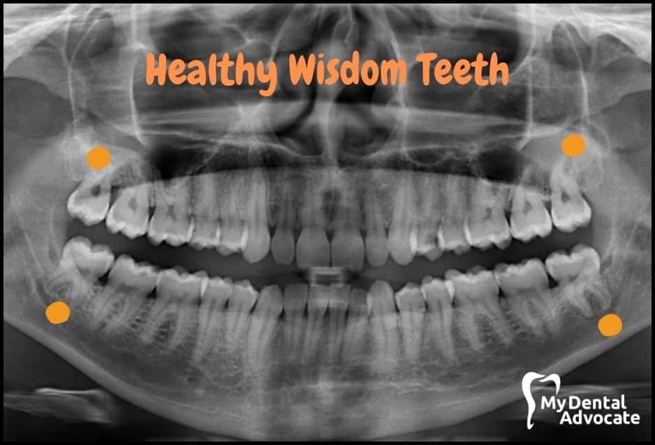 Healthy Wisdom Teeth | My Dental Advocate