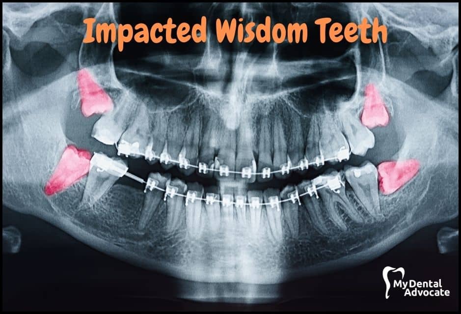 Impacted Wisdom Teeth X-ray | My Dental Advocate