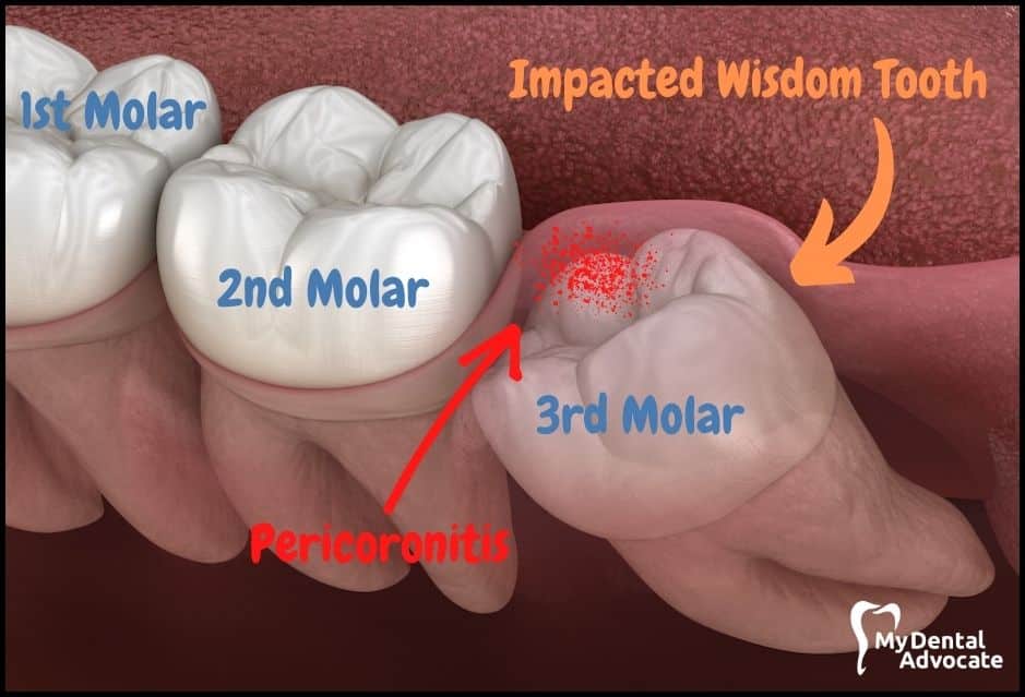 Impacted Wisdom Tooth Graphic | My Dental Advocate