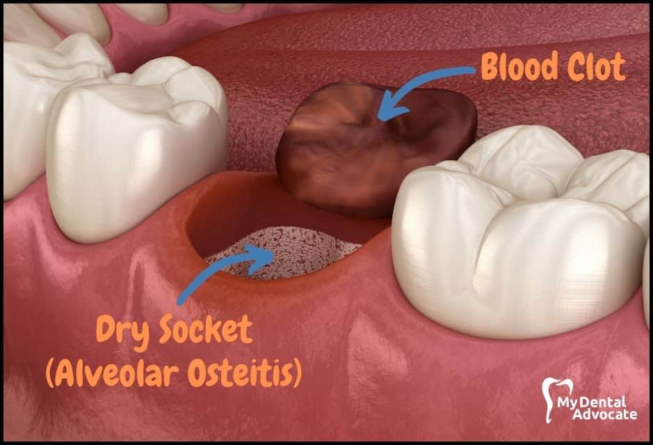 Dry Socket Blood Clot | My Dental Advocate